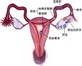 有盆腔积液会影响怀孕吗